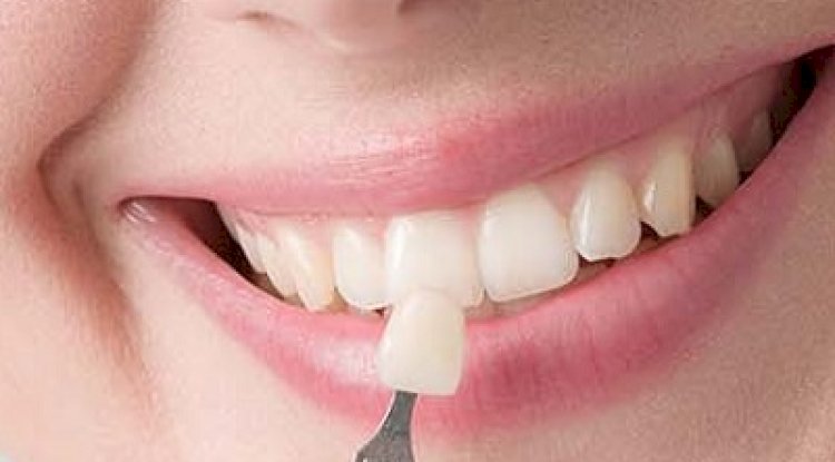 Is There Pain During or After Composite Veneers?