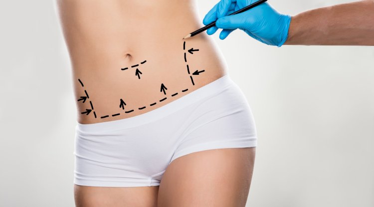 The Future of Liposuction: Trends to Watch in 2025 and Beyond