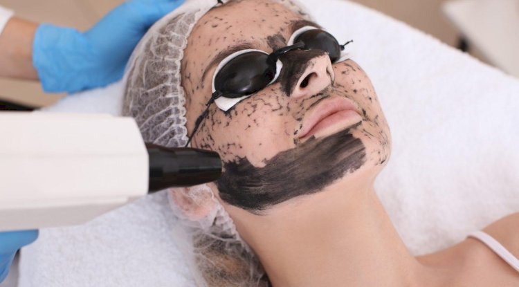 Can Laser Carbon Peel Help With Acne and Oily Skin?