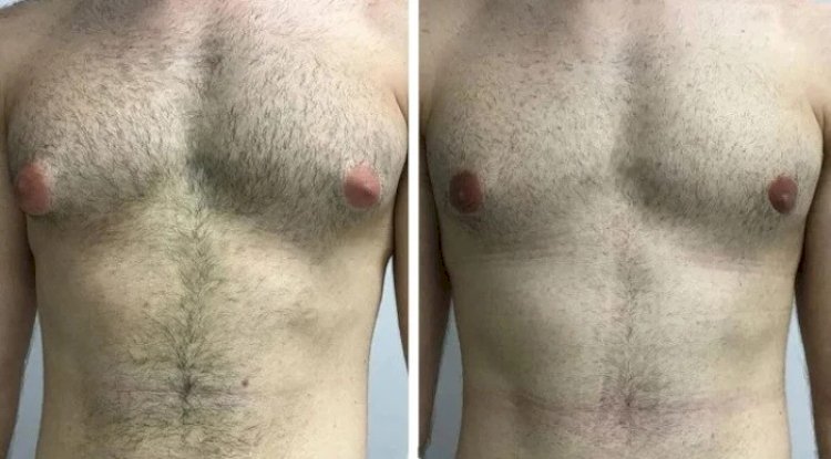 Before and After Gynecomastia: Real Results from the Best Doctors in Dubai