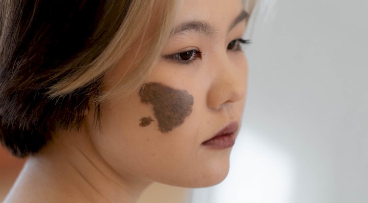 How Does Laser Birthmark Removal Work?