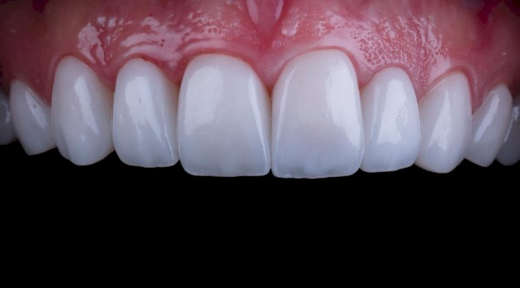 Composite Veneers and Diet: How Food Impacts Longevity