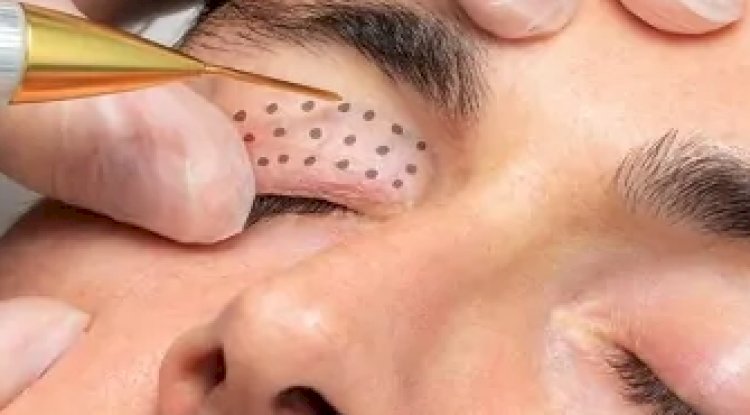 What Areas Can Be Treated with Plasma Pen?