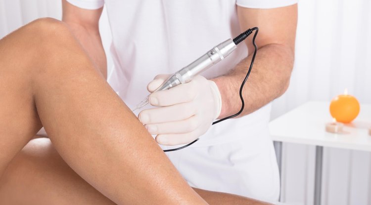 How MCA Microneedling Targets Stretch Marks for Visible Skin Renewal