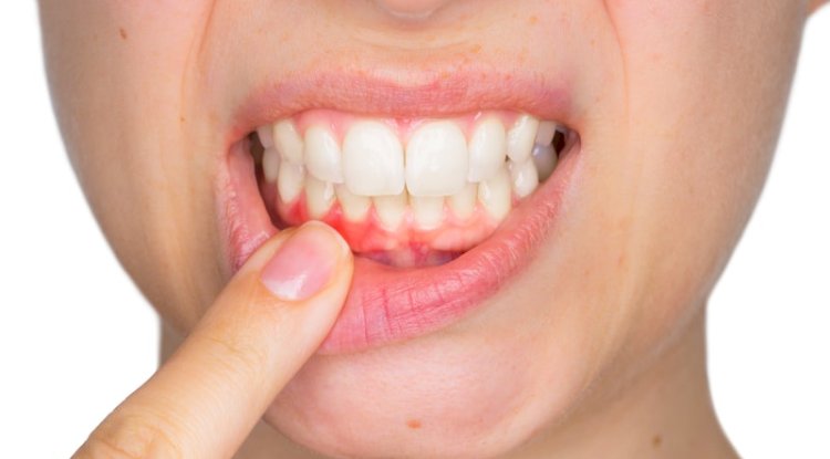 What Your Gums Say About Your Health - Dental Pros Explain