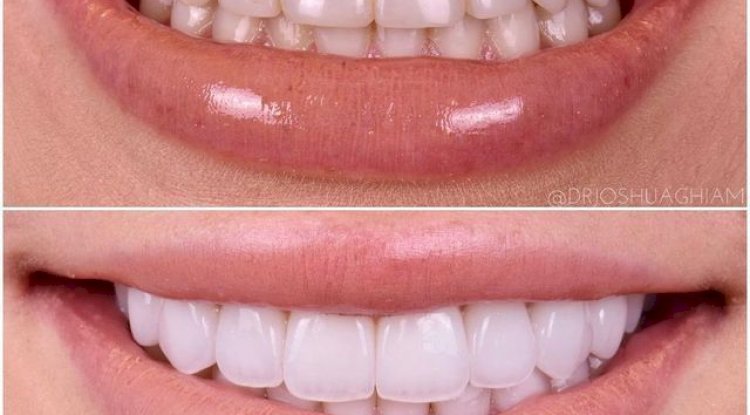 Dental Implants in Sacramento: A Complete Guide to Restoring Your Smile