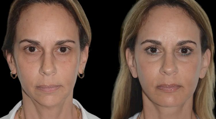 Best Aesthetic Clinics in Dubai for Chin Fillers: Enhance Your Facial Contours