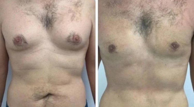How the Best Gynecomastia Surgeons in Dubai Minimize Scarring