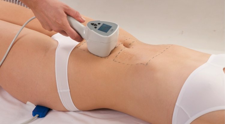 How Many Sessions Are Needed for Exilis Treatment?