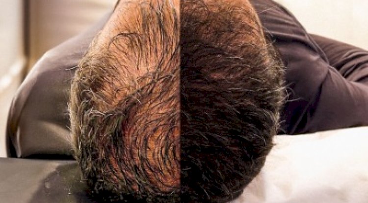Does Hair Transplantation Work for Everyone in Islamabad?