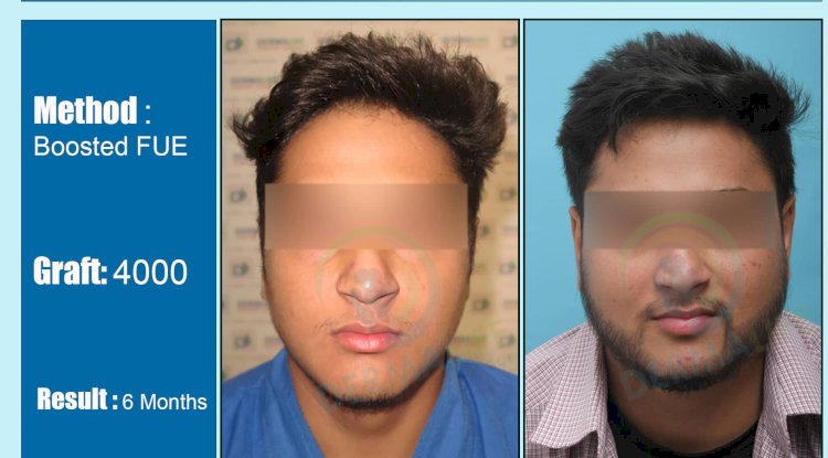 Understanding the Need for Beard Hair Transplant