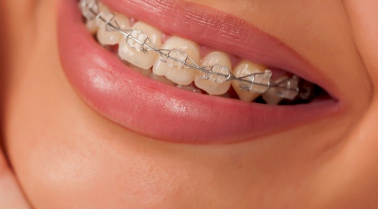6 Common Braces Problems and How to Fix Them