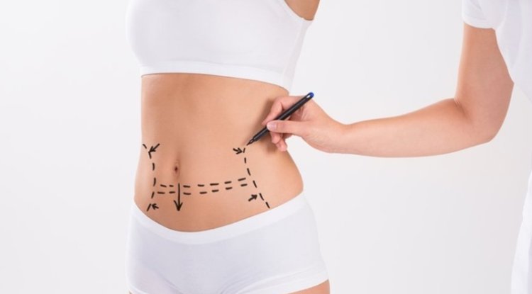 Skin Tightening and Tummy Tuck in Islamabad