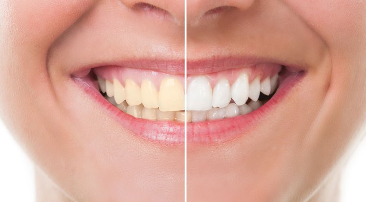 Why Teeth Whitening Cost Varies So Much in Different Places