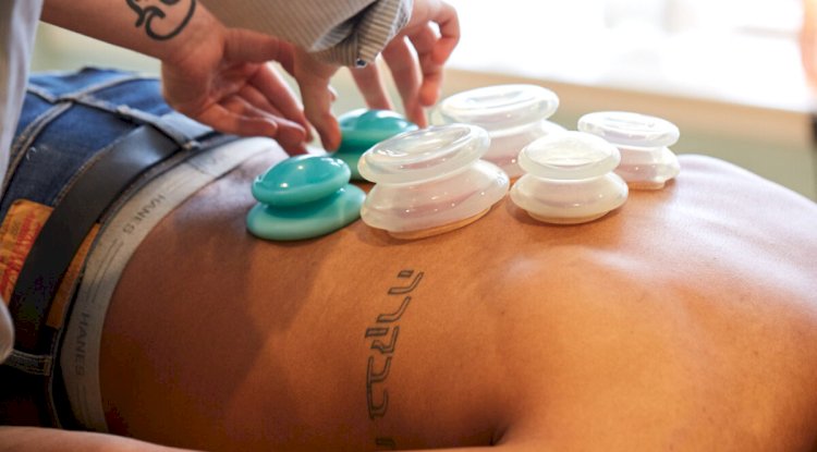 Cupping Therapy in Philadelphia: Ancient Healing Reimagined