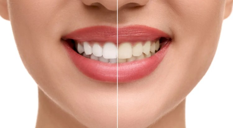 What Tiny Habits Drive Up Teeth Whitening Cost?