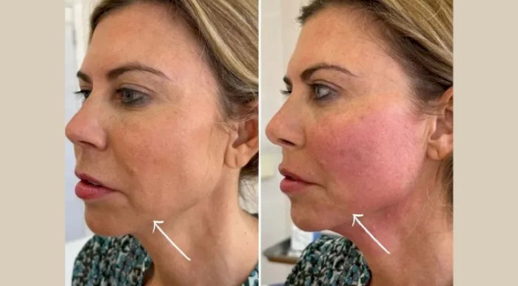 What to Expect During Your First Endolift in Dubai Treatment