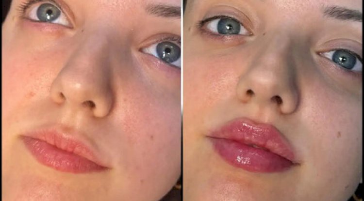 Best Plastic Surgeons in dubai for Non-Surgical Neck and Chin Fillers