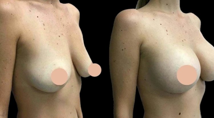 Breast Augmentation Surgery in Dubai: A Guide to Long-Term Maintenance