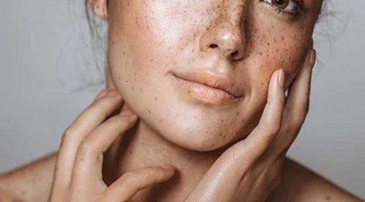 Are Natural Melasma Treatments Really Effective Long-Term?