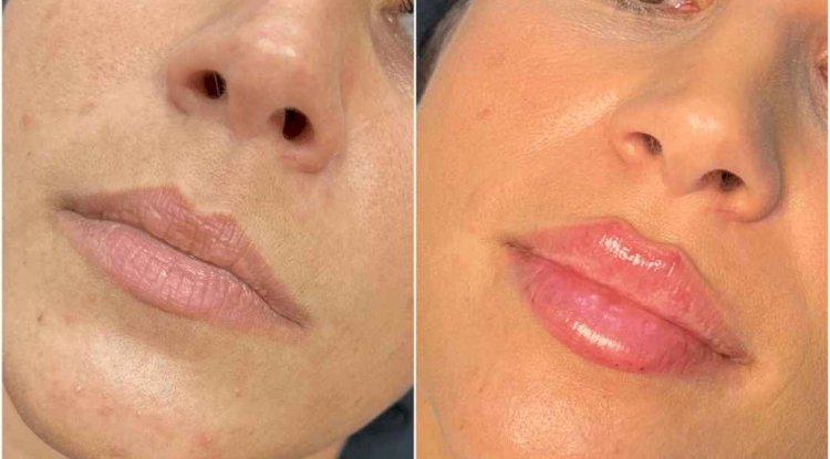 The Secret to Youthful Skin with Juvederm: A Step-by-Step Guide from the Best Plastic Surgeon in Dubai