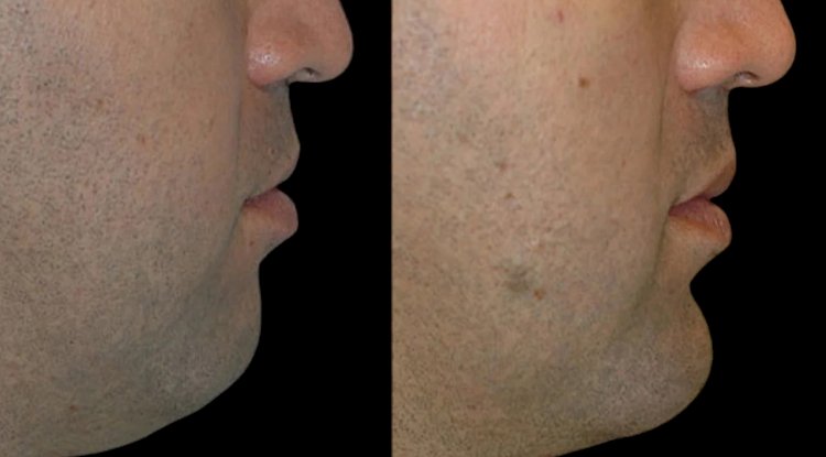 A Step-by-Step Guide to Chin Fillers with the Best Plastic Surgeon in Dubai
