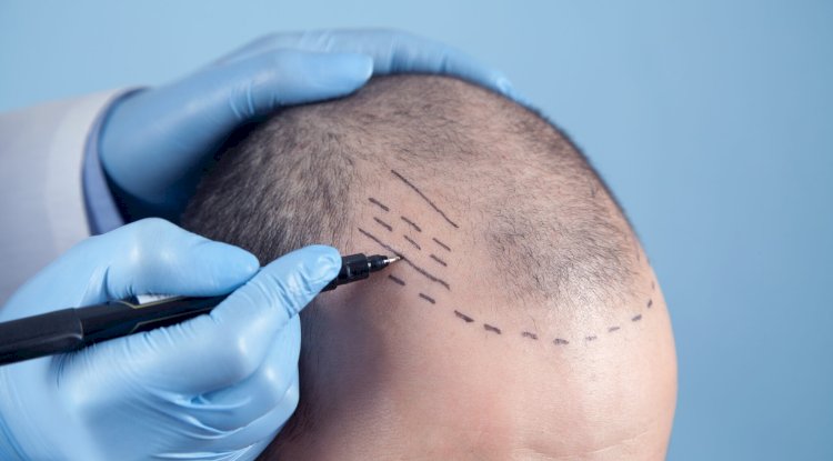 Can You Get a Crown Hair Transplant at Age 25?
