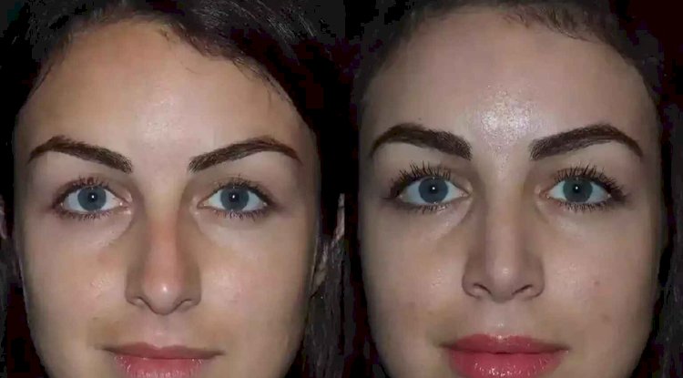 How Best Septoplasty Surgeons in Dubai Are Redefining Nasal Health