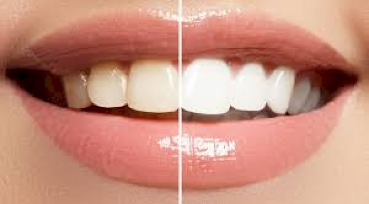 How to Budget for Teeth Whitening Cost Without Surprises