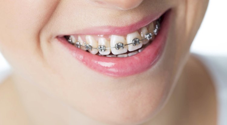 Who Should Avoid Low Teeth Braces Costs in Dubai?