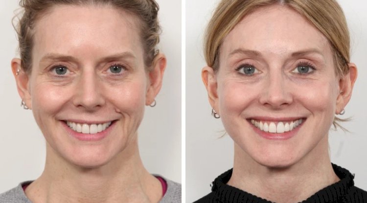 Thread Lift Recovery Timeline Explained by the Best Doctors in Dubai