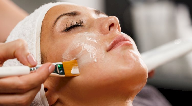 What Are the Benefits of Getting a Chemical Peel?