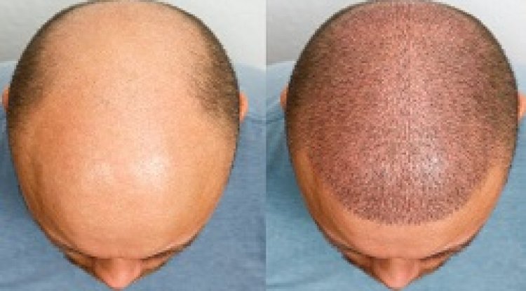 فوائد زراعة الشعر في الرياض مقارنة بالعلاجات الأخرى