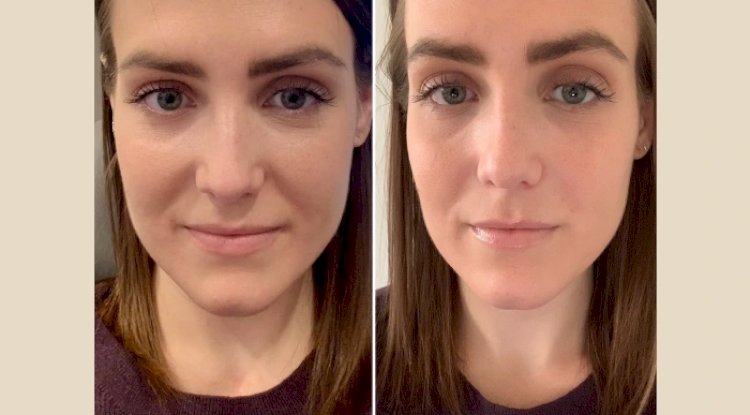 PRP Treatment in Dubai: A Complete Guide for Beginners