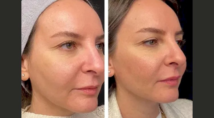 Mesotherapy Treatment in Dubai for Glowing Skin: How It Works
