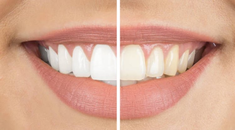 Is Teeth Whitening Cost Higher for Sensitive Teeth Cases?