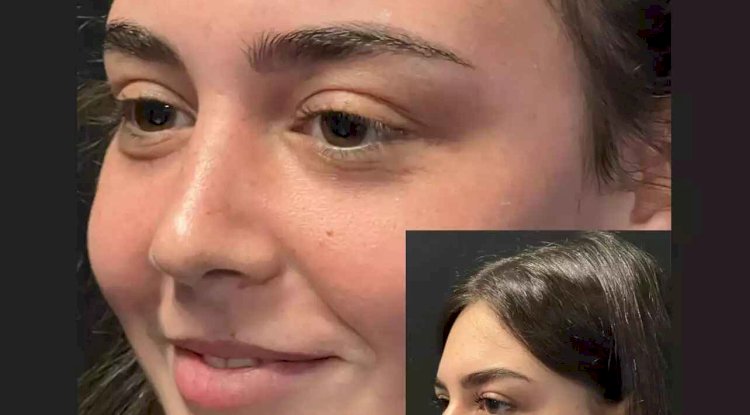 What Results Can the Best Septoplasty Surgeons in Dubai Deliver?