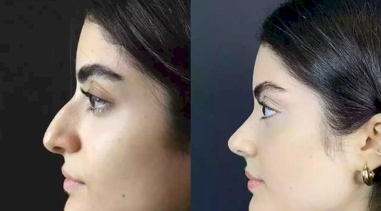 Can the Best Rhinoplasty Surgeon in Dubai Achieve Subtle Enhancements?