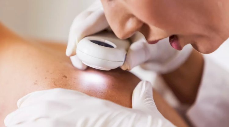 What Aftercare Is Needed for Skin Tag Removal in Dubai?