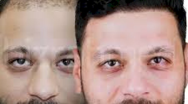 ما الذي يحدد تكلفة زراعة الشعر في الرياض؟