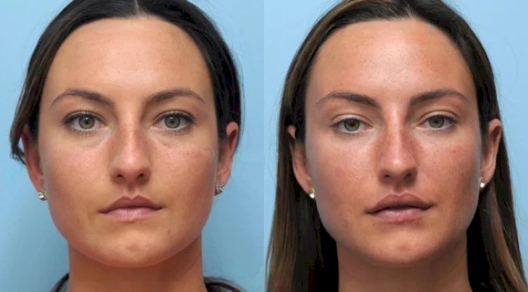 Achieve Flawless Contours Using Thread Lift Provided by the Best Doctors in Dubai