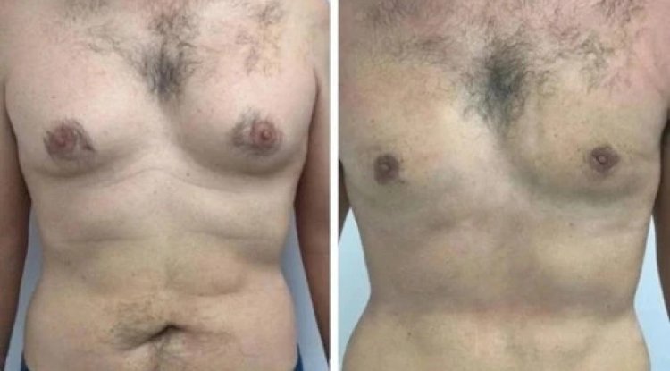 Gynecomastia in Dubai: Choosing the Right Surgeon for You
