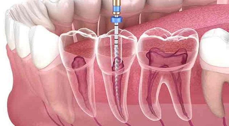 How Long Does It Take to Heal After Root Canal Treatment?