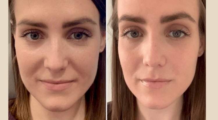 PRP Treatment in Dubai: What to Expect During Your First Session