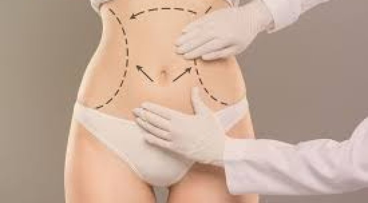 Tummy Tuck for Stretch Marks Reduction in Islamabad