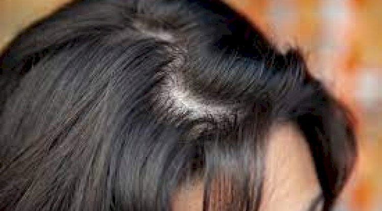 Hair Loss Treatment or Hair Transplant: Which Should You Choose?