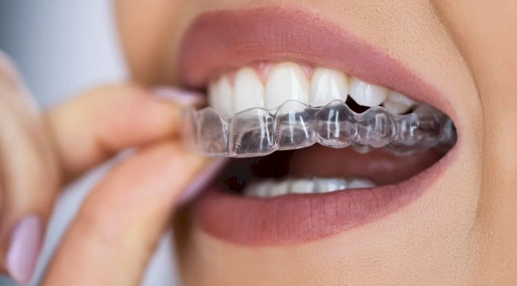 Dental Appliances for TMJ Disorders