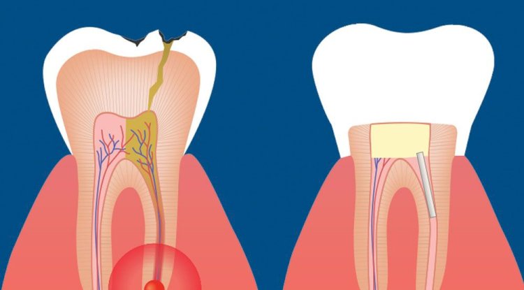 Can a Root Canal Treatment Prevent Future Tooth Pain?