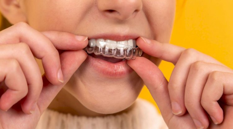 Do You Need Retainers After Invisalign Braces Treatment?