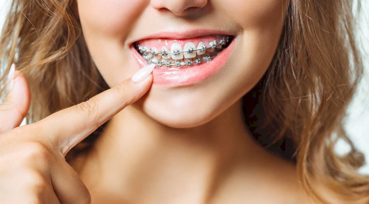 How Do Teeth Braces Costs in Dubai Impact Treatment Choice?